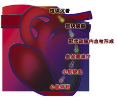 BECKMANCOULTER貝克曼庫爾特新一代預(yù)測(cè)心肌梗死試劑-Accu TnI